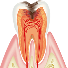 虫歯治療